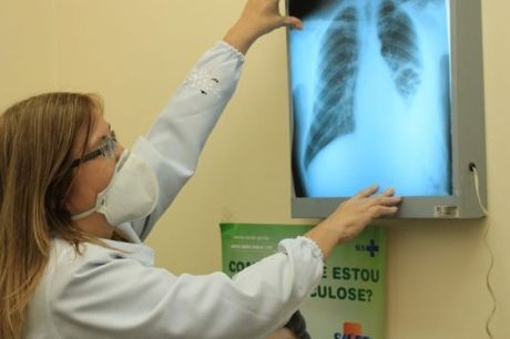 Brasil está na contramão da meta da OMS para extinção da tuberculose